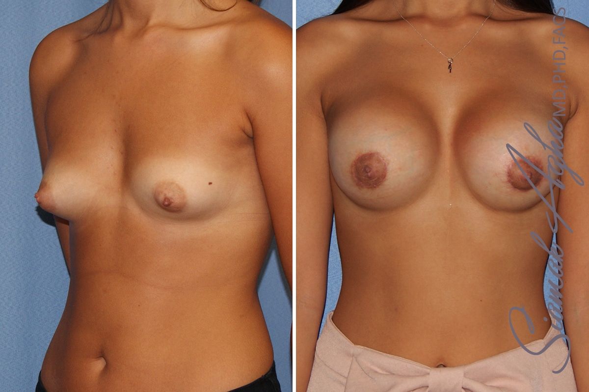 Breast Augmentation Before & After