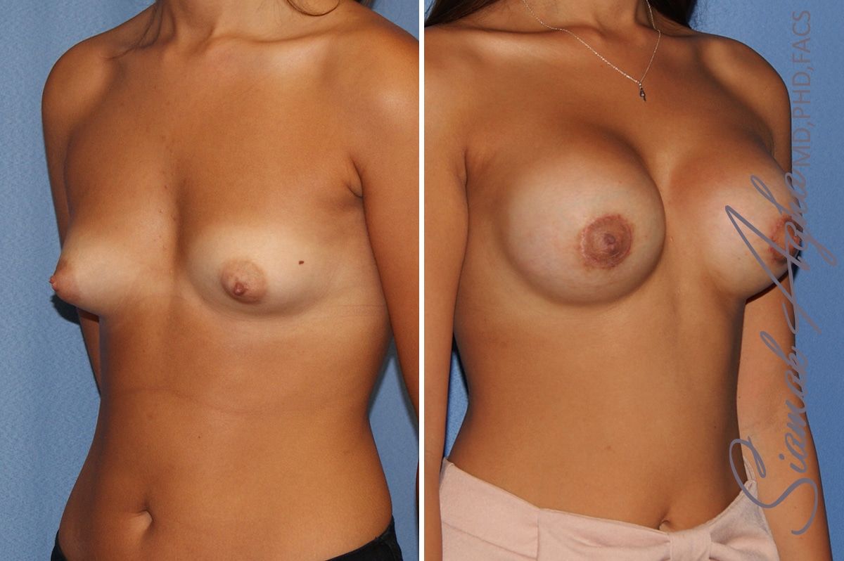 Breast Augmentation Before & After
