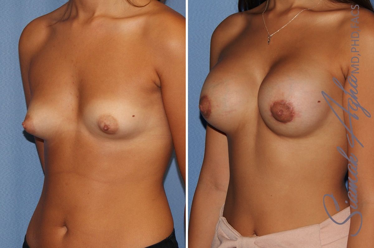 Breast Augmentation Before & After