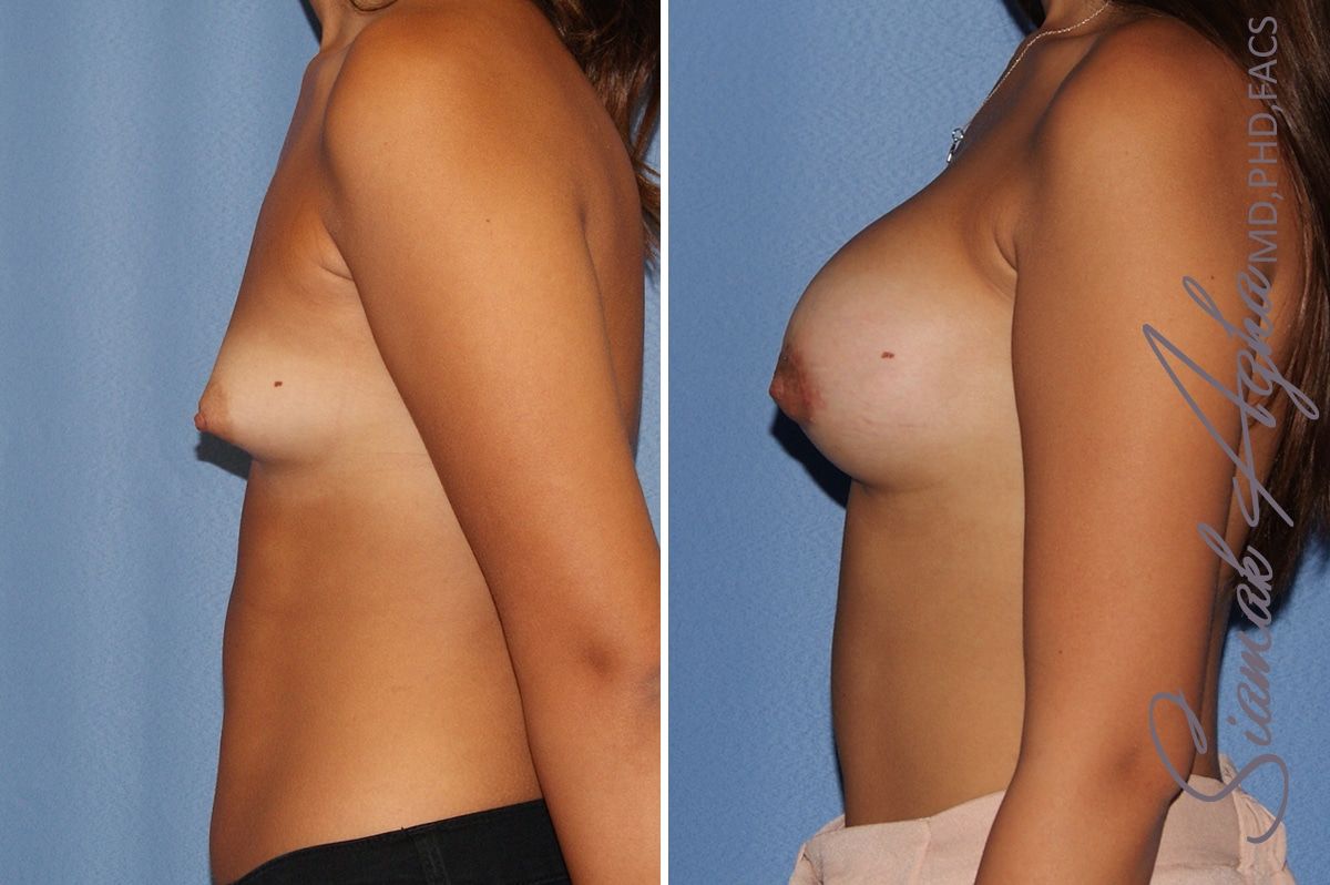 Breast Augmentation Before & After