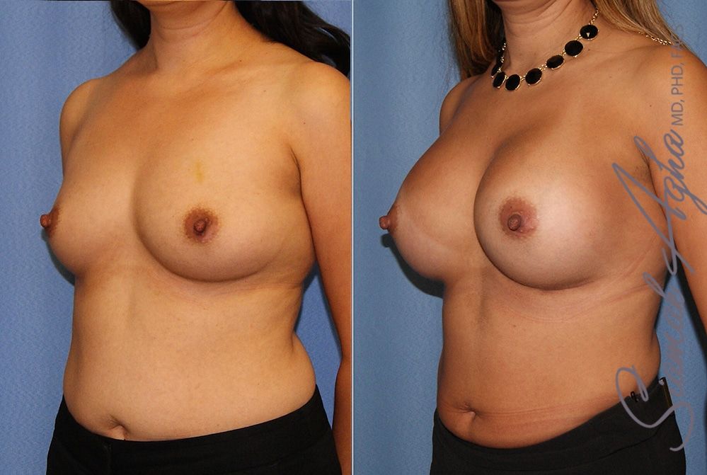 Breast Augmentation Before & After