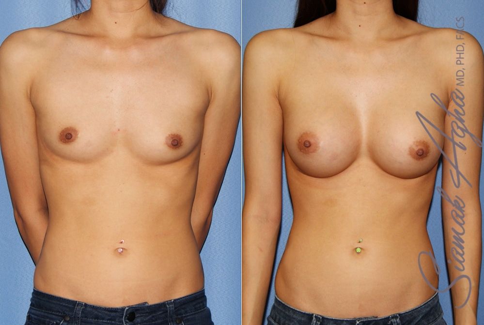 Breast Augmentation Before & After