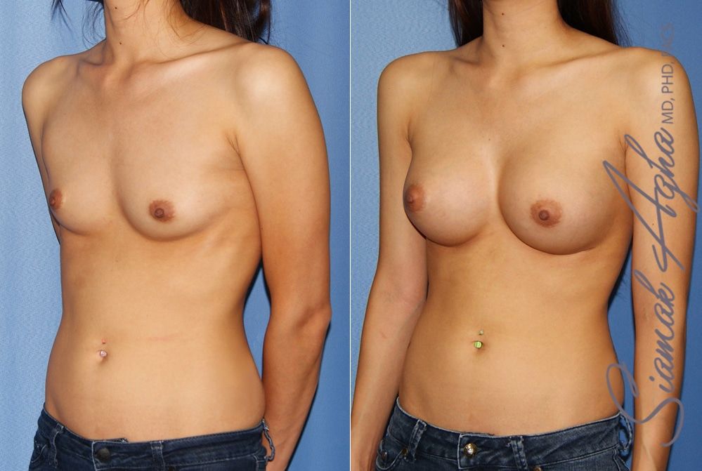 Breast Augmentation Before & After