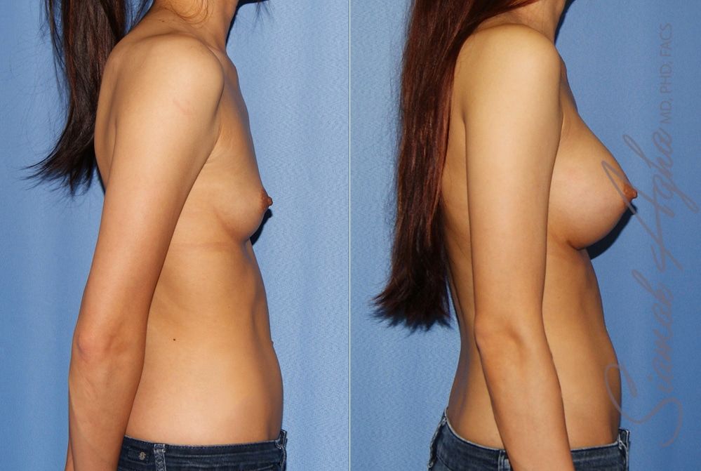 Breast Augmentation Before & After