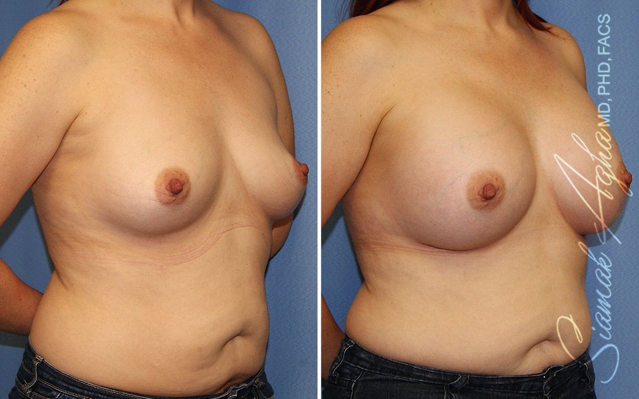 Breast Augmentation Before & After