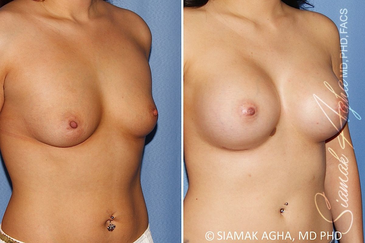 Breast Augmentation Before & After