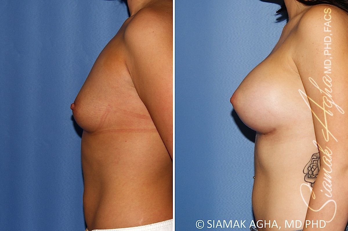 Breast Augmentation Before & After