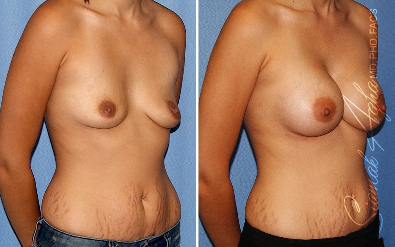 Breast Augmentation Before & After