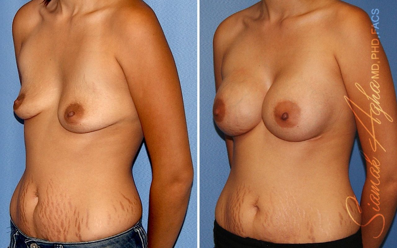 Breast Augmentation Before & After