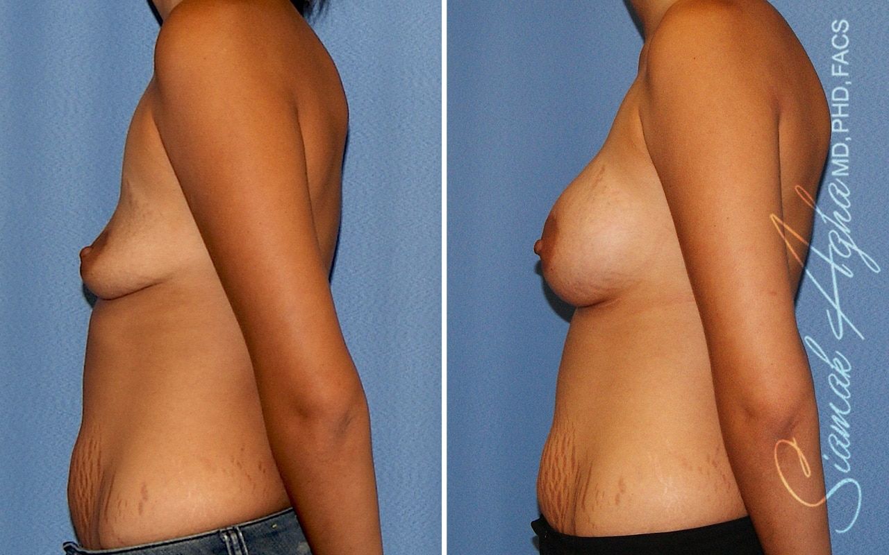 Breast Augmentation Before & After