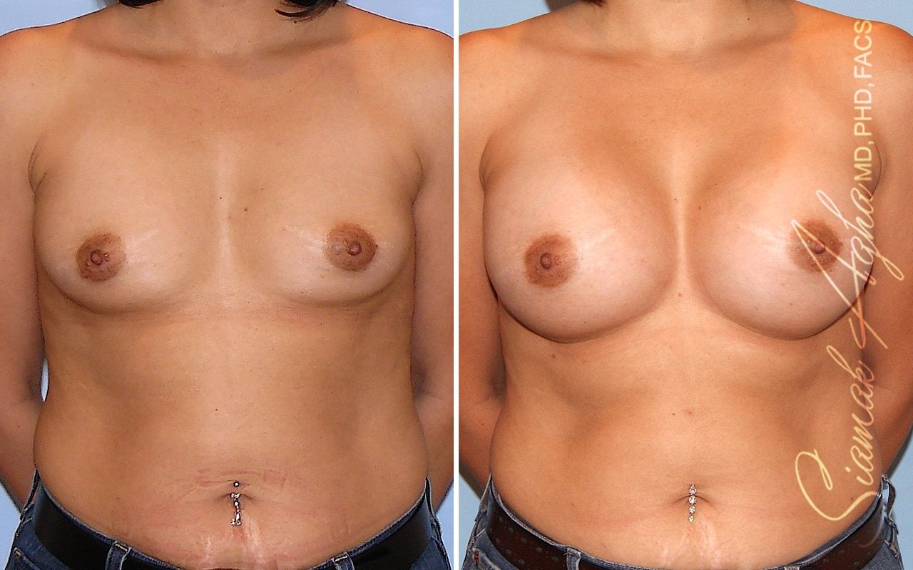 Breast Augmentation Before & After