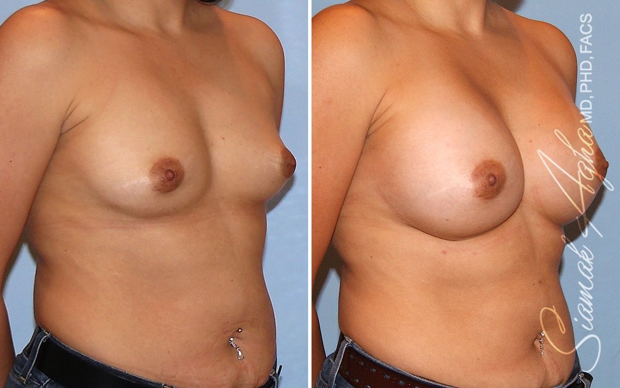 Breast Augmentation Before & After