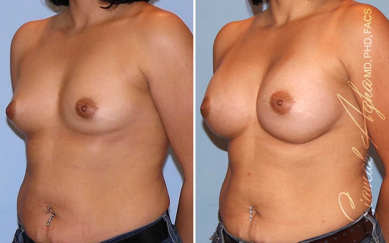 Breast Augmentation Before & After
