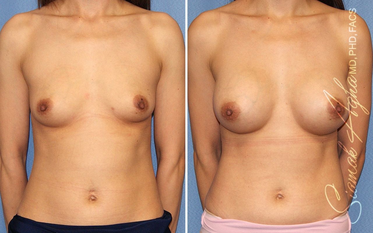 Breast Augmentation Before & After