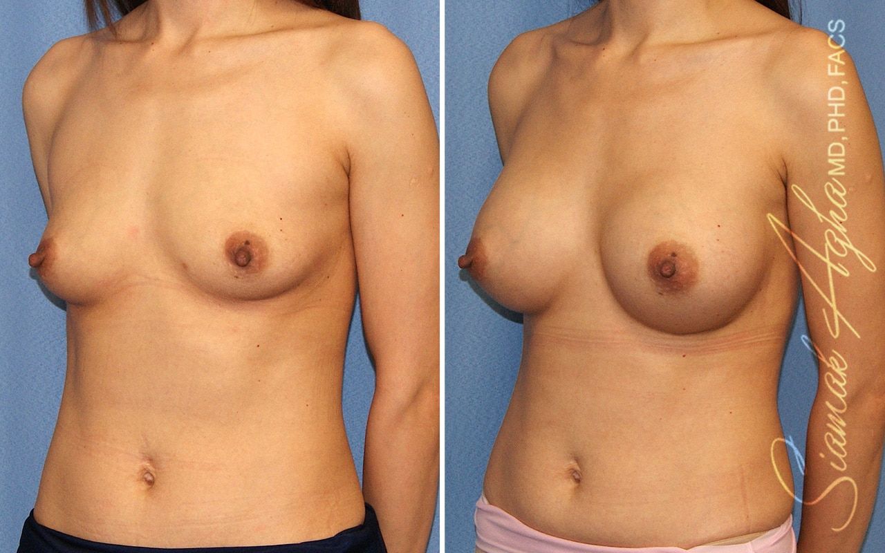 Breast Augmentation Before & After