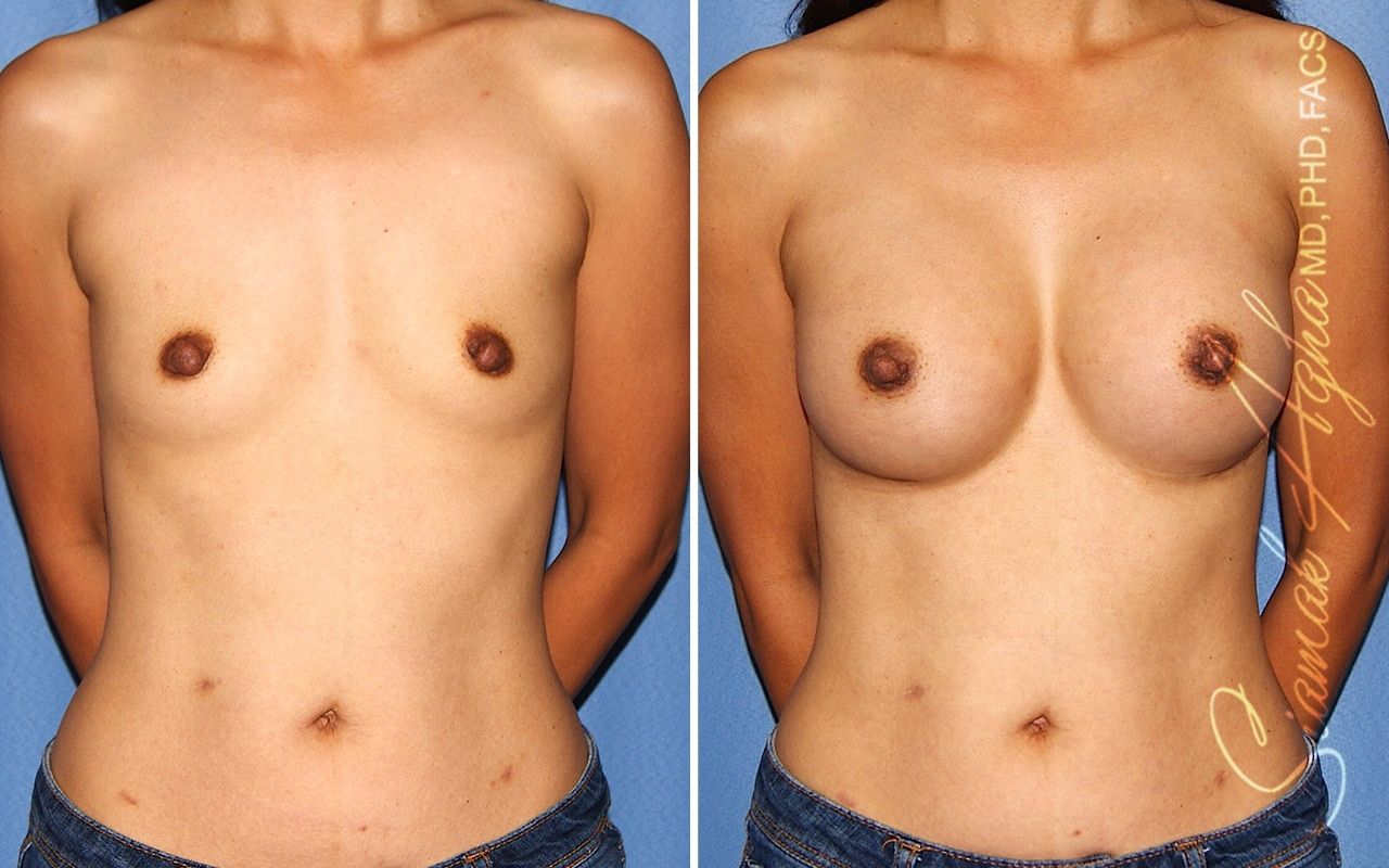 Breast Augmentation Before & After