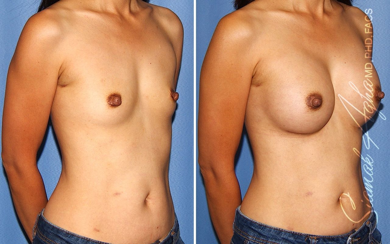 Breast Augmentation Before & After