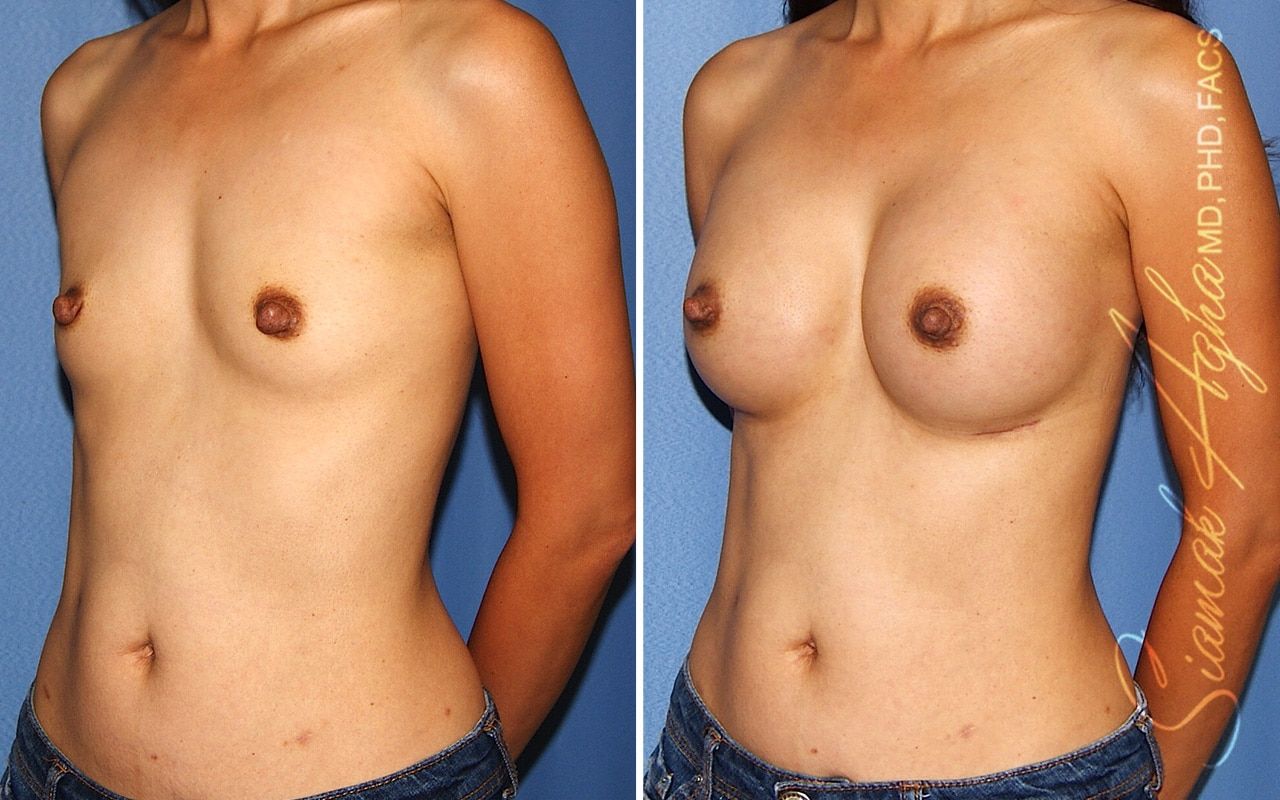 Breast Augmentation Before & After