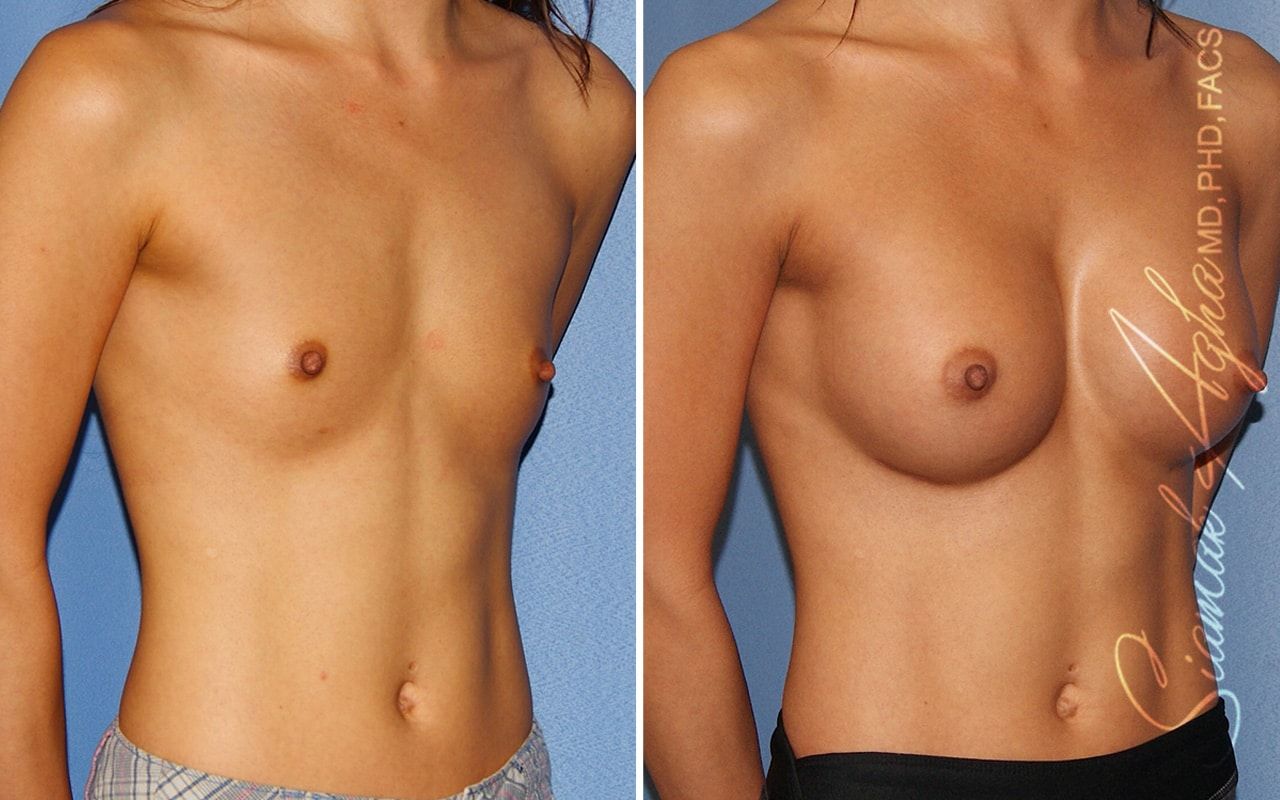 Breast Augmentation Before & After