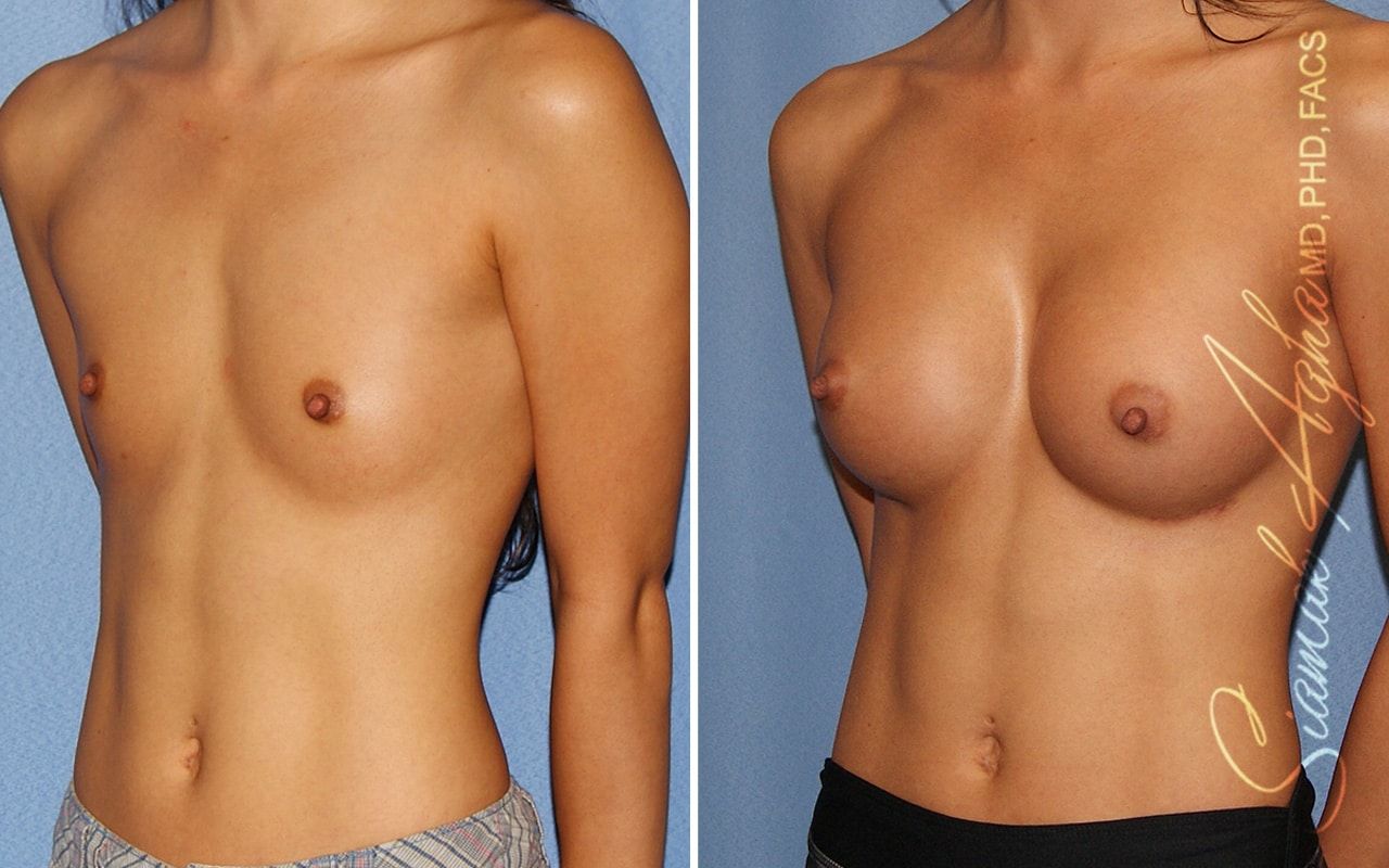 Breast Augmentation Before & After