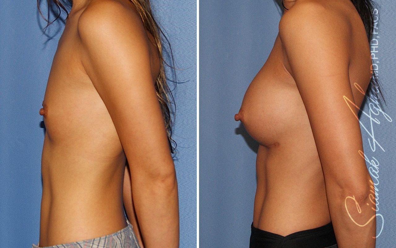 Breast Augmentation Before & After