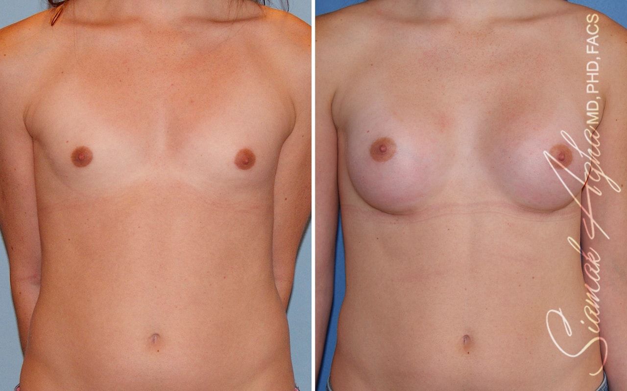 Breast Augmentation Before & After
