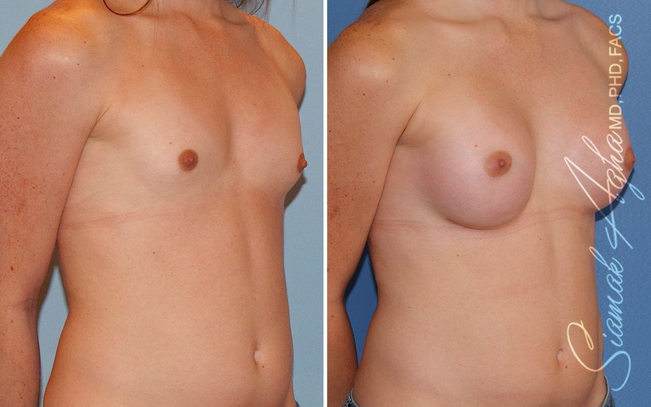 Breast Augmentation Before & After