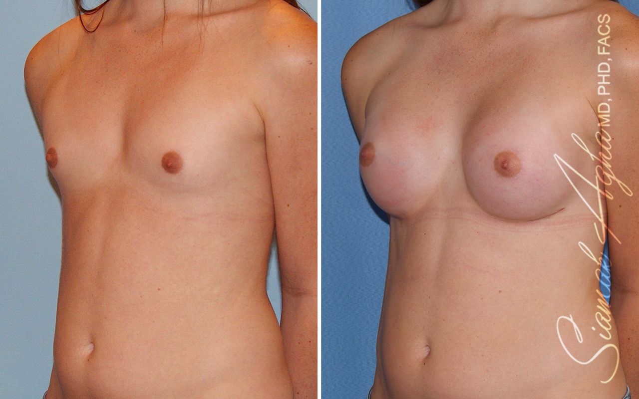 Breast Augmentation Before & After