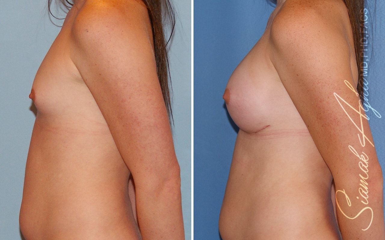 Breast Augmentation Before & After