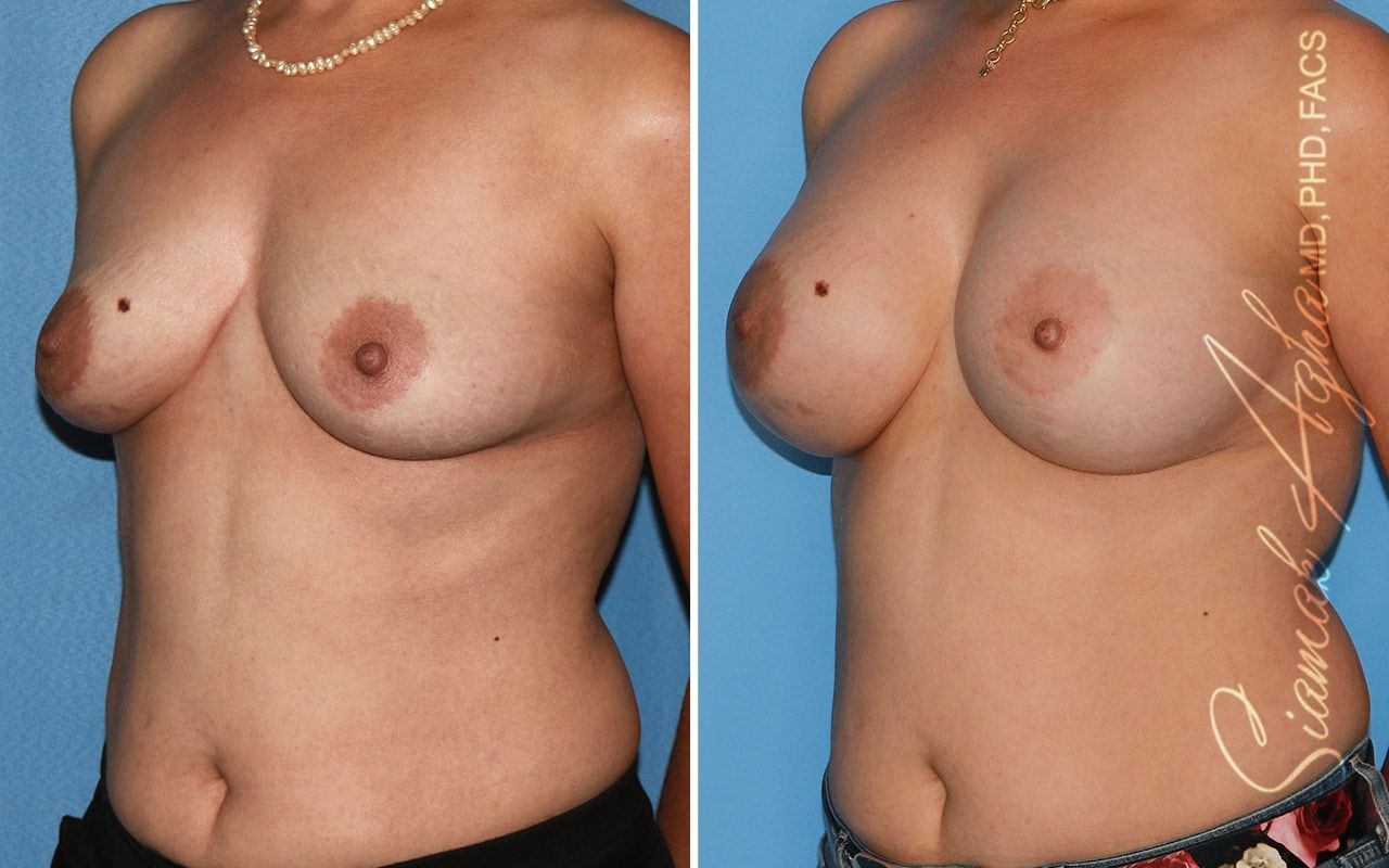 Breast Augmentation Before & After