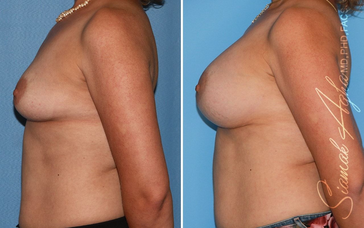Breast Augmentation Before & After