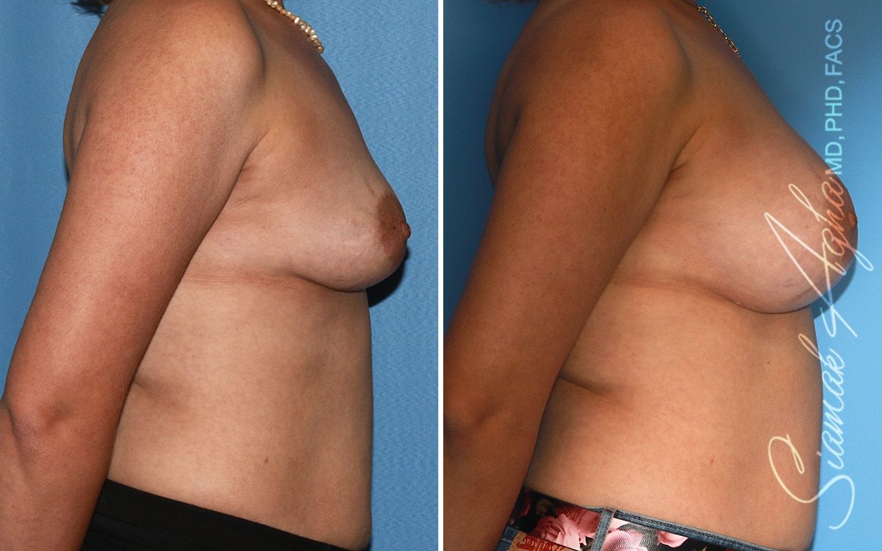 Breast Augmentation Before & After