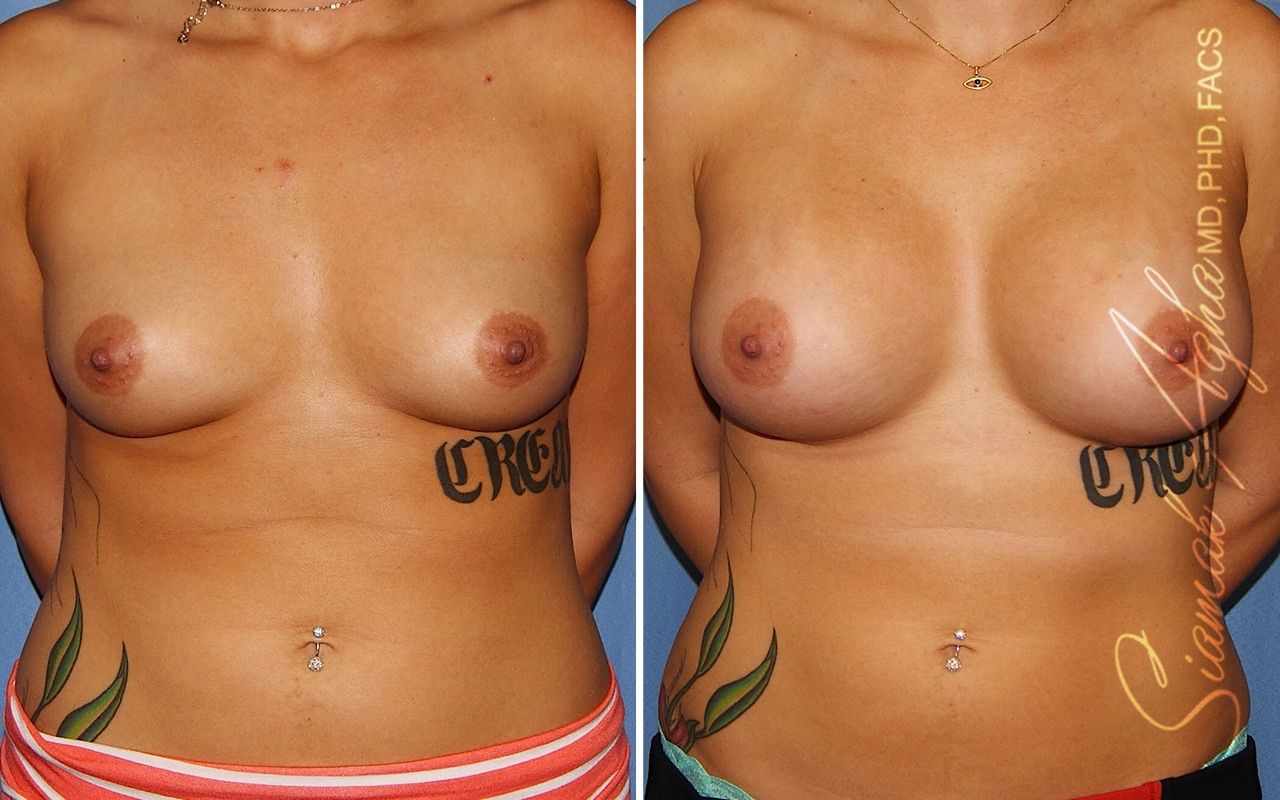 Breast Augmentation Before & After