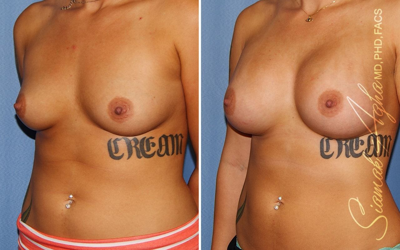 Breast Augmentation Before & After