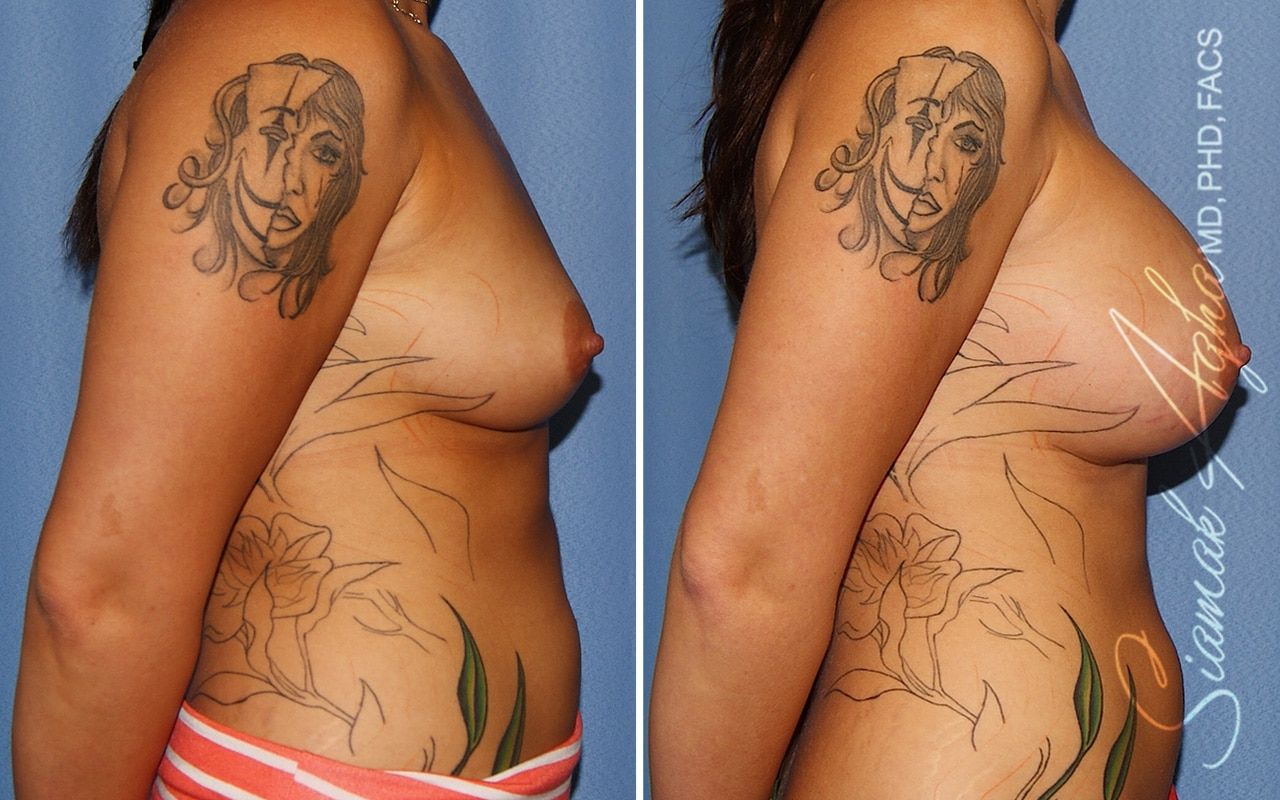 Breast Augmentation Before & After