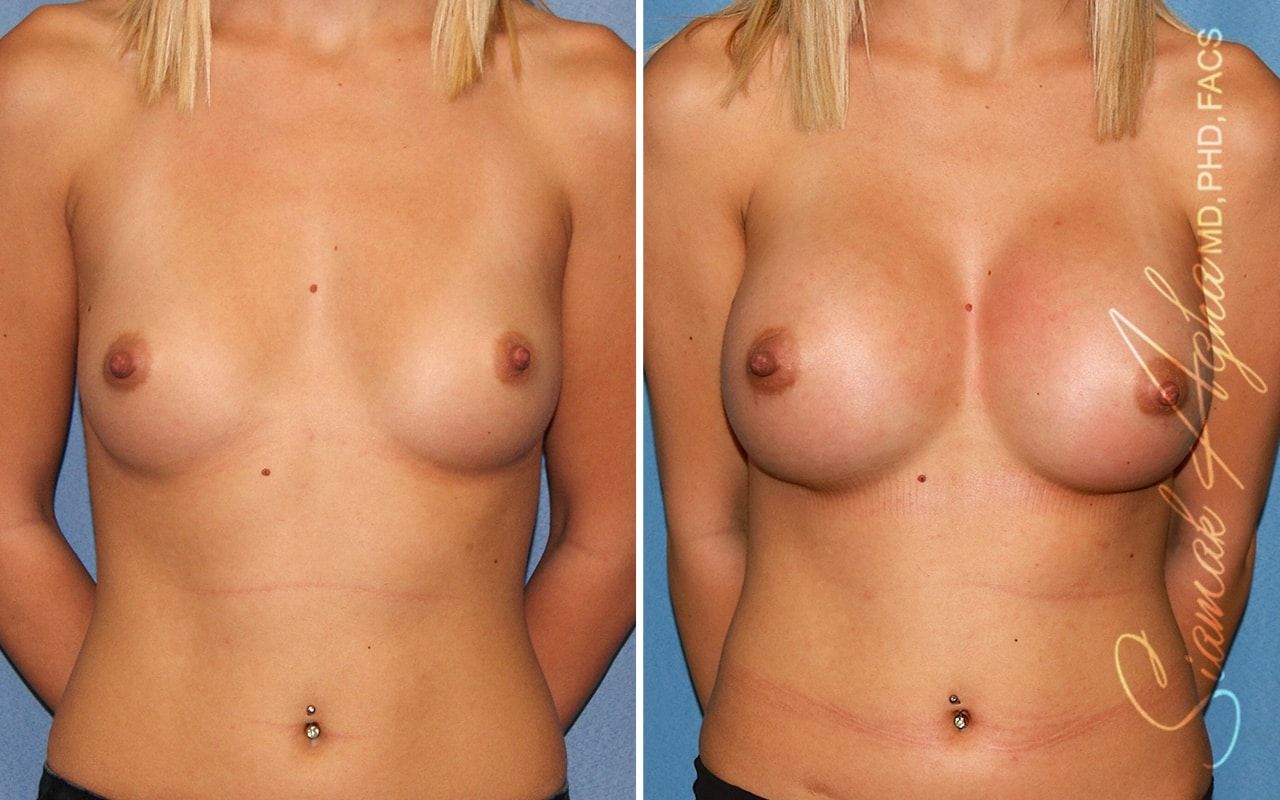 Breast Augmentation Before & After