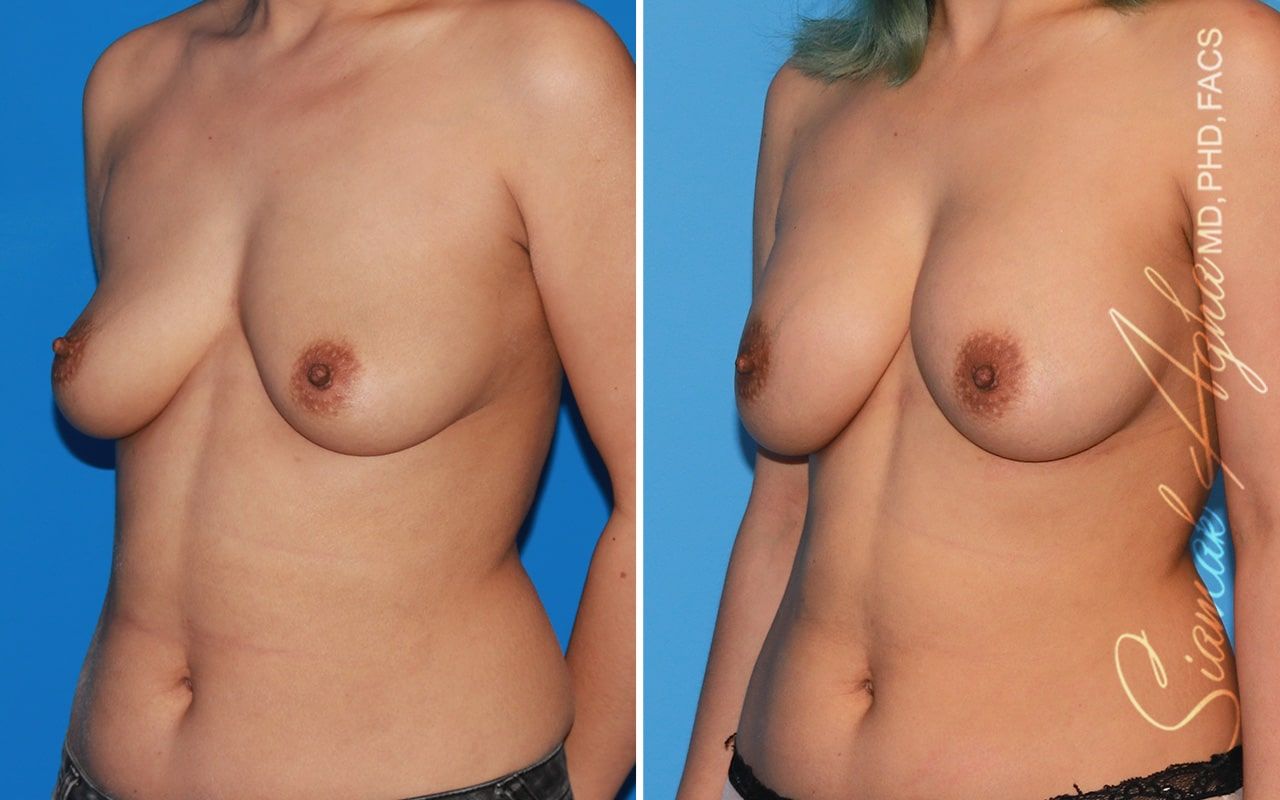 Breast Augmentation Before & After