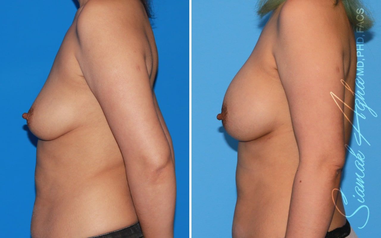 Breast Augmentation Before & After