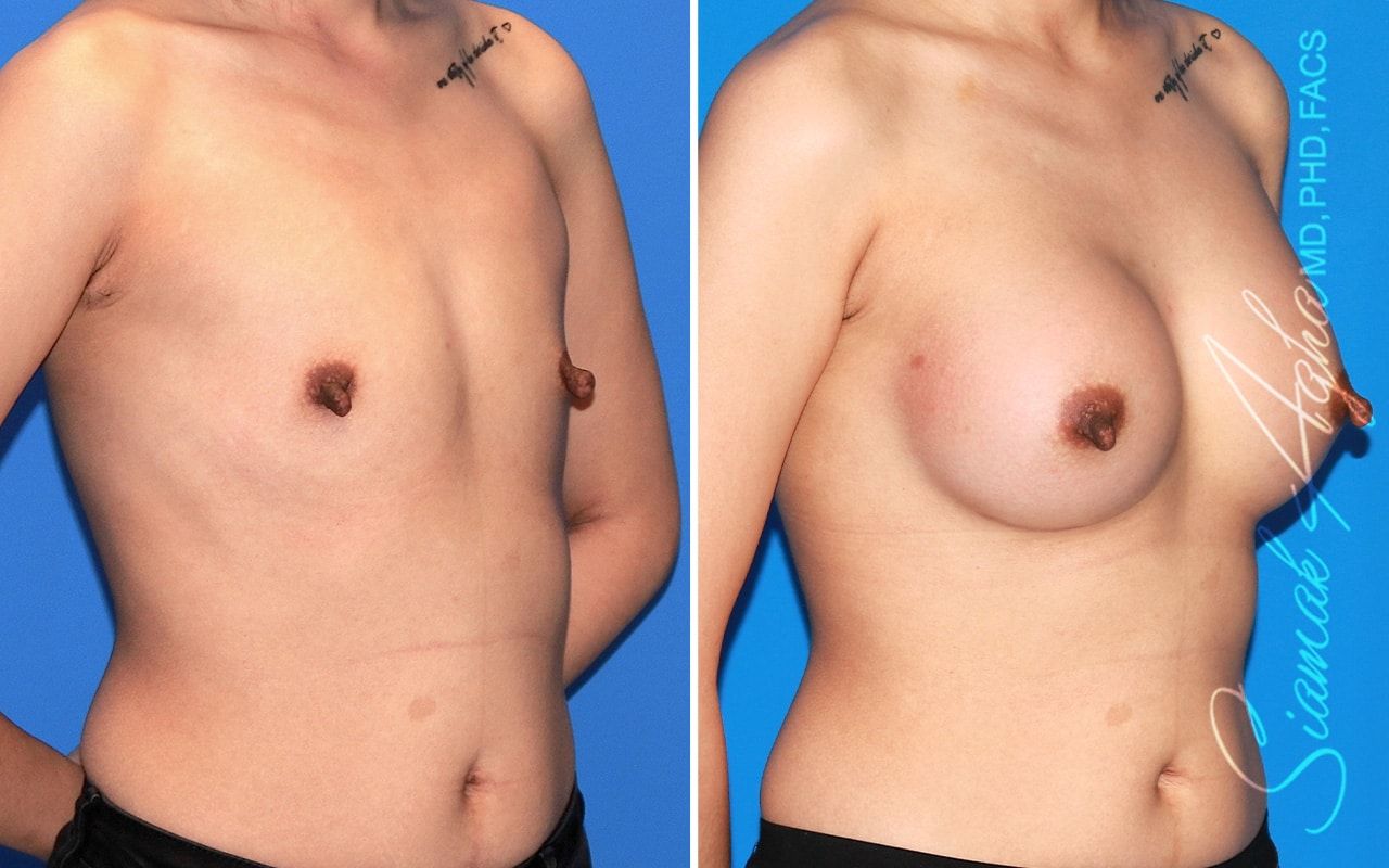 Breast Augmentation Before & After