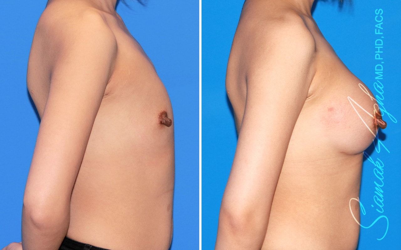 Breast Augmentation Before & After