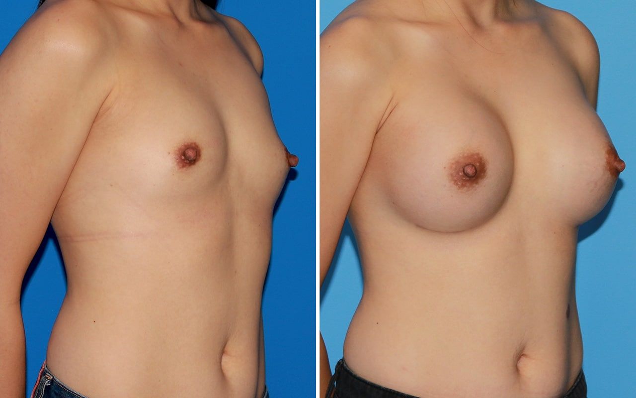 Breast Augmentation Before & After