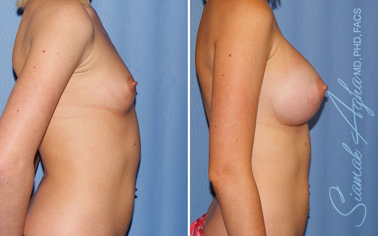 Breast Augmentation Before & After