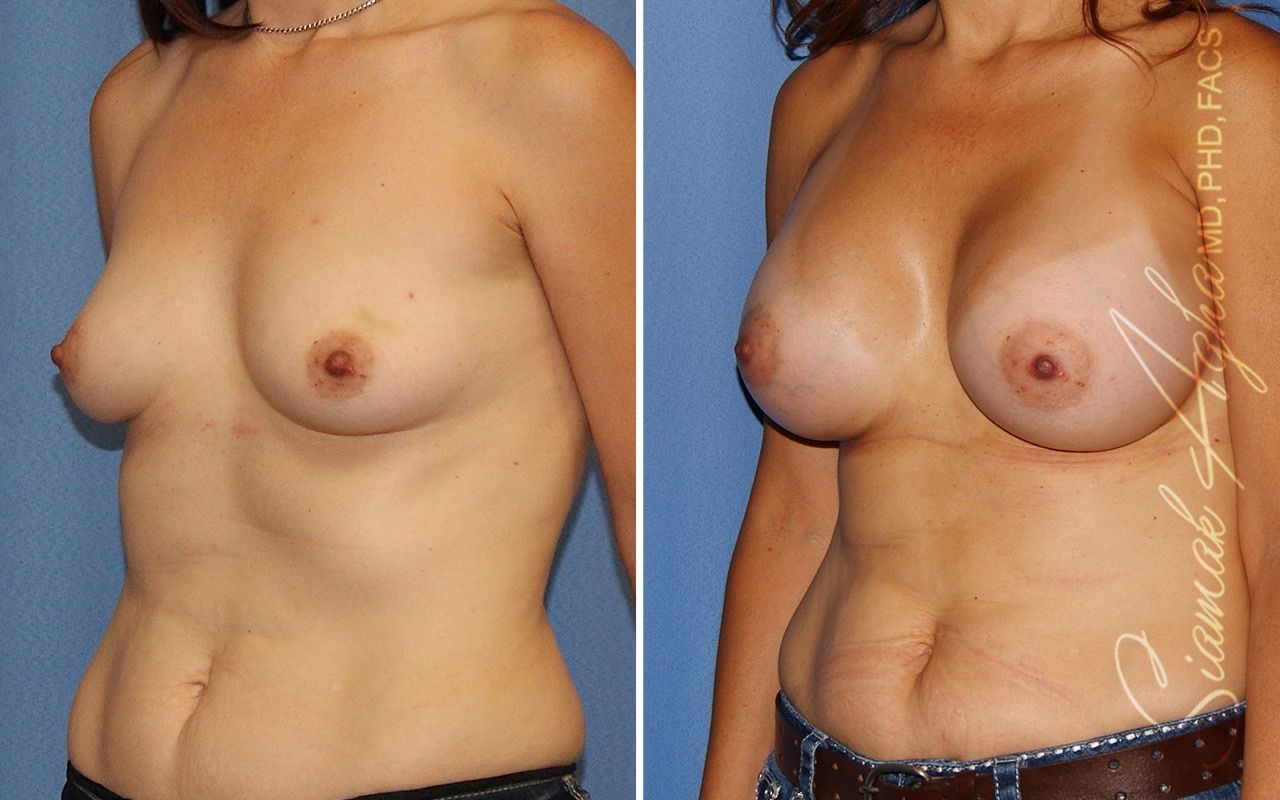 Breast Augmentation Before & After