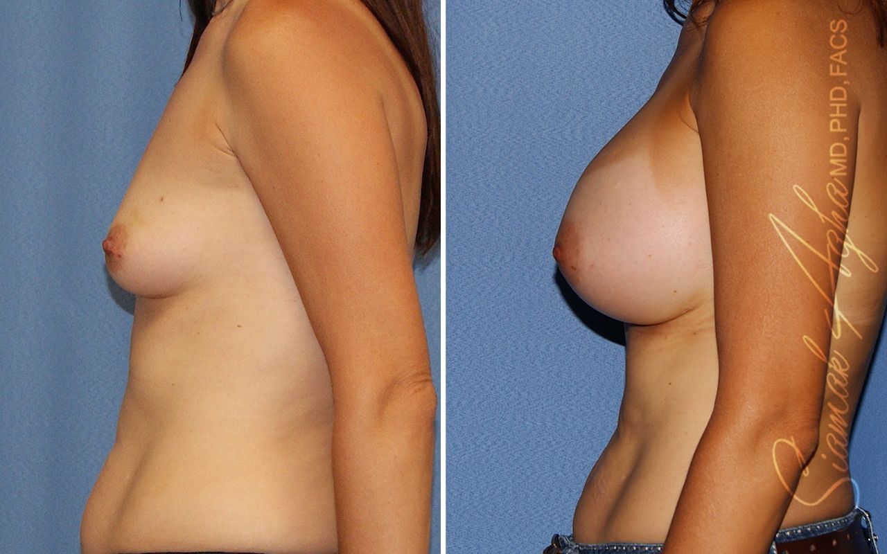 Breast Augmentation Before & After