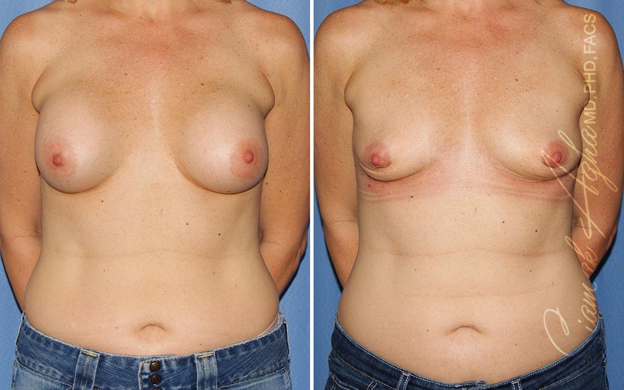Breast Implant Removal Before & After