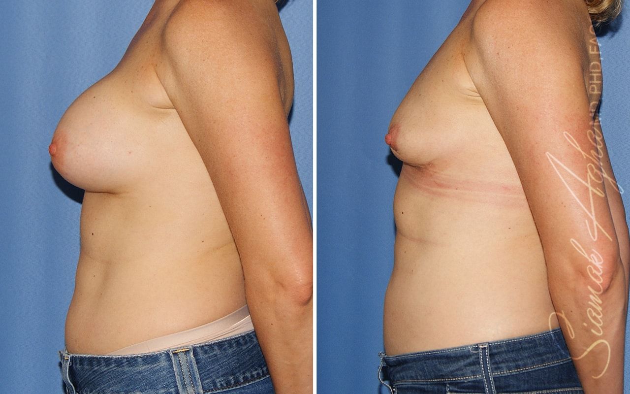 Breast Implant Removal Before & After