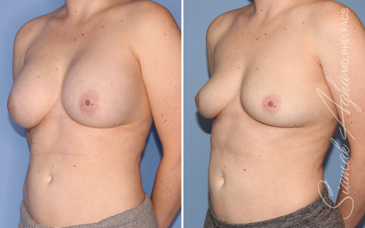 Breast Implant Removal Before & After