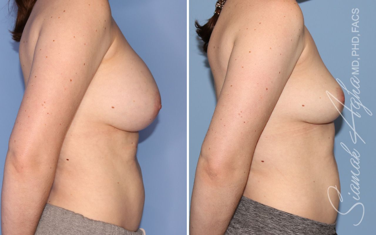 Breast Implant Removal Before & After