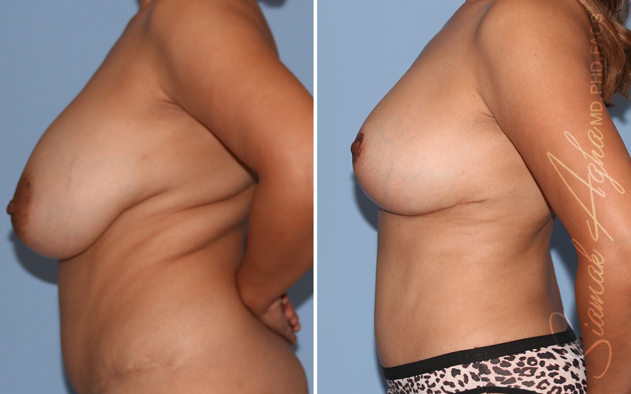 Breast Implant Removal Before & After