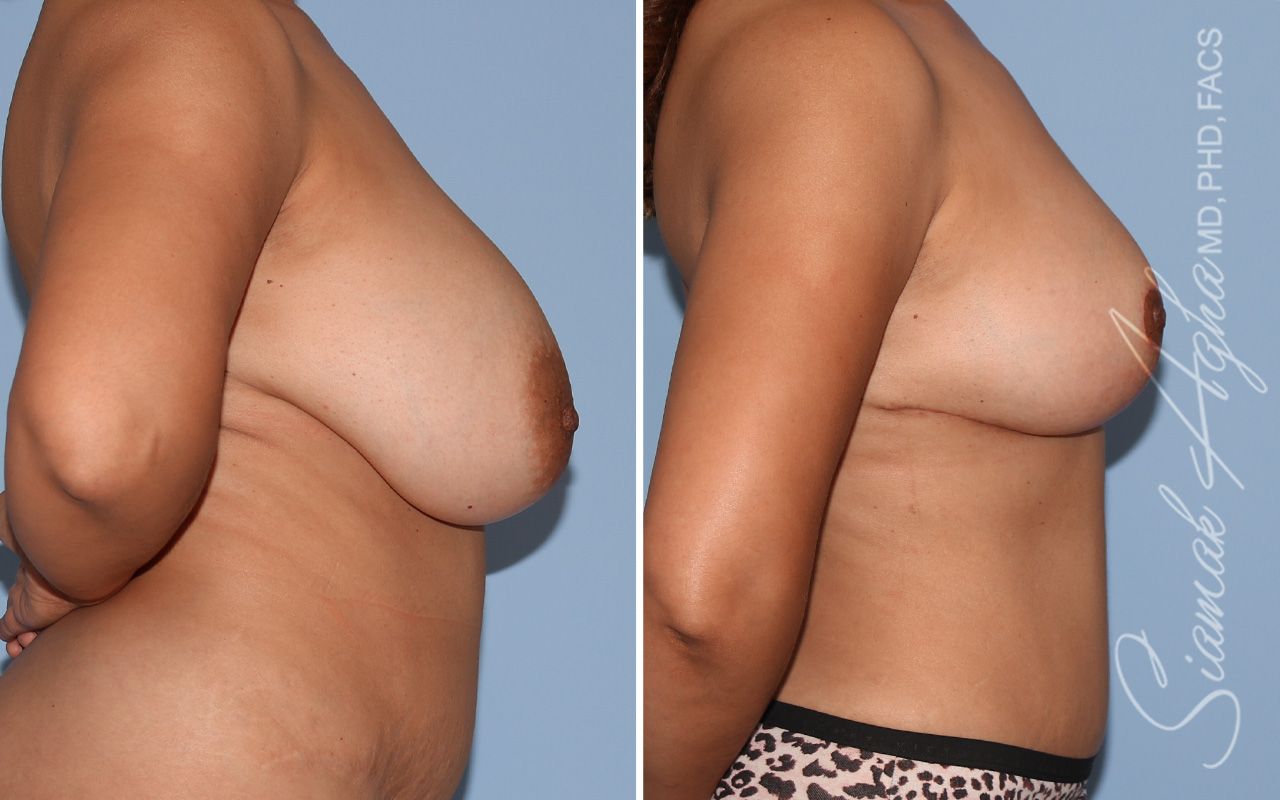 Breast Implant Removal Before & After